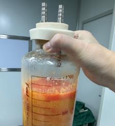 黔东南水动力吸脂手术要做多久？